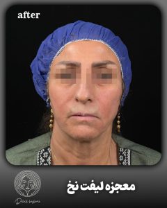 لیفت نخ در کلینیک دکتر هاشمی