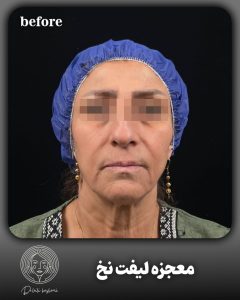 پکیج لیفت نخ