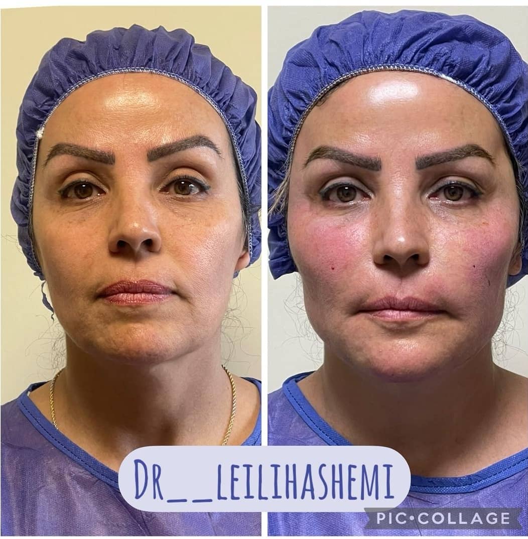 لیفت با نخ در تهران