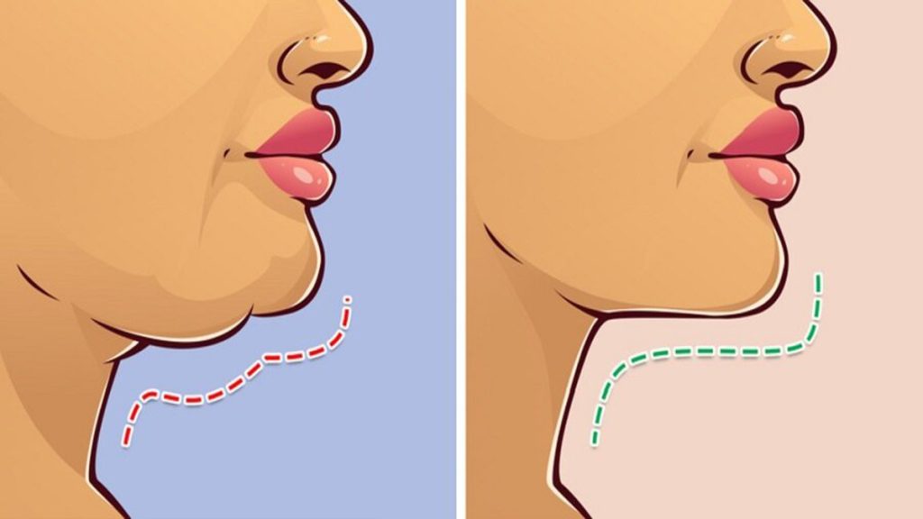 امبدینگ غبغب چیست