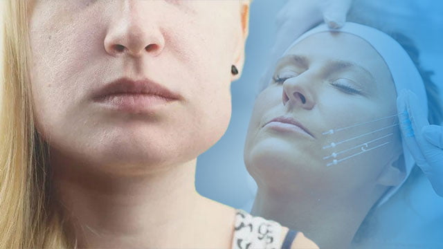 دلایل ورم پوست صورت بعد از لیفت با نخ چیست؟