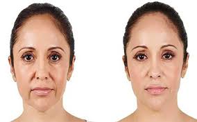 مزایا و معایب تزریق فیلر خط خنده: